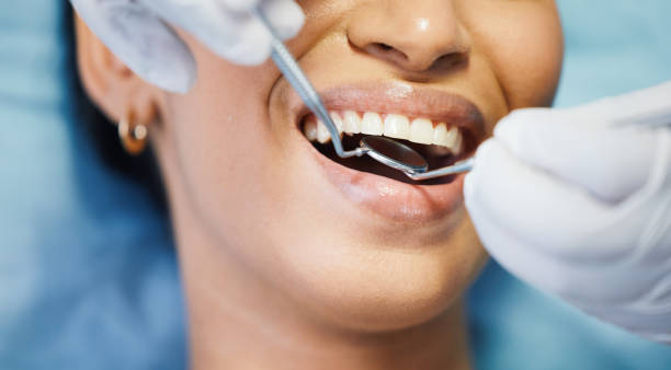 Best Chipped Tooth Repair Near Me  in Elberton, GA